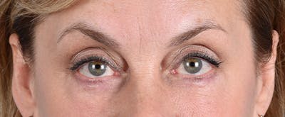 Hidden Patients Before & After Gallery - Patient 561726 - Image 2