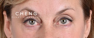 Hidden Patients Before & After Gallery - Patient 561726 - Image 2