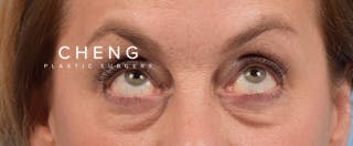 Hidden Patients Before & After Gallery - Patient 561726 - Image 3