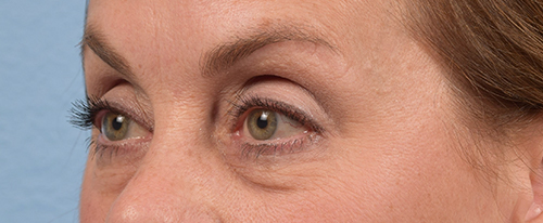 Hidden Patients Before & After Gallery - Patient 561726 - Image 5