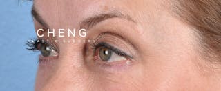 Hidden Patients Before & After Gallery - Patient 561726 - Image 6