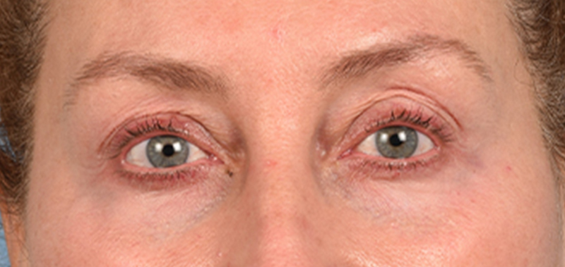 Hidden Patients Before & After Gallery - Patient 379996 - Image 1