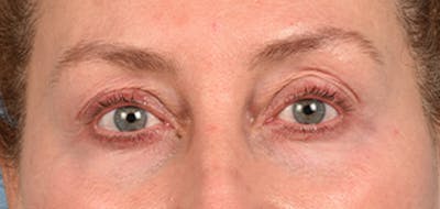 Hidden Patients Before & After Gallery - Patient 379996 - Image 1