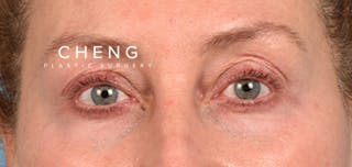 Hidden Patients Before & After Gallery - Patient 379996 - Image 1