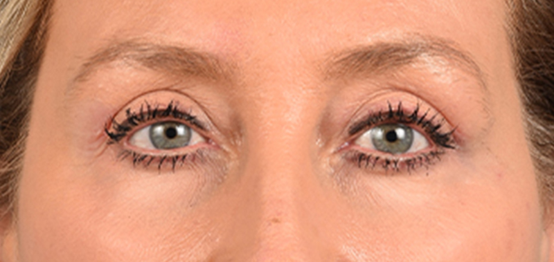 Hidden Patients Before & After Gallery - Patient 379996 - Image 2