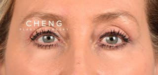 Hidden Patients Before & After Gallery - Patient 379996 - Image 2