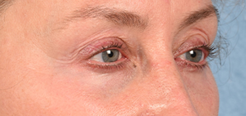 Hidden Patients Before & After Gallery - Patient 379996 - Image 3