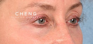Hidden Patients Before & After Gallery - Patient 379996 - Image 3