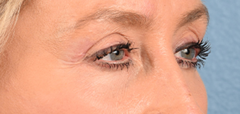 Hidden Patients Before & After Gallery - Patient 379996 - Image 4