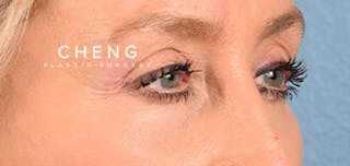 Hidden Patients Before & After Gallery - Patient 379996 - Image 4