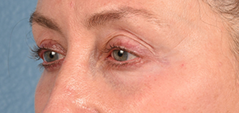 Hidden Patients Before & After Gallery - Patient 379996 - Image 5