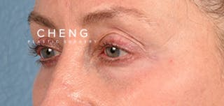 Hidden Patients Before & After Gallery - Patient 379996 - Image 5