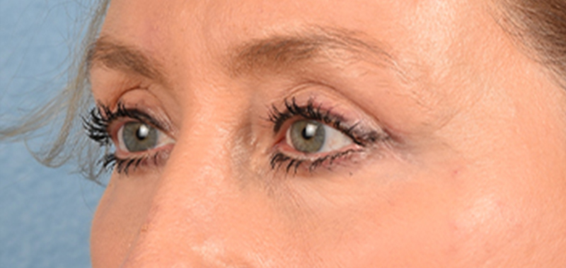 Hidden Patients Before & After Gallery - Patient 379996 - Image 6