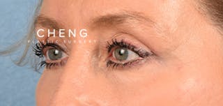 Hidden Patients Before & After Gallery - Patient 379996 - Image 6