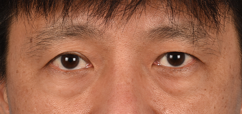 Blepharoplasty Before & After Gallery - Patient 394322 - Image 1