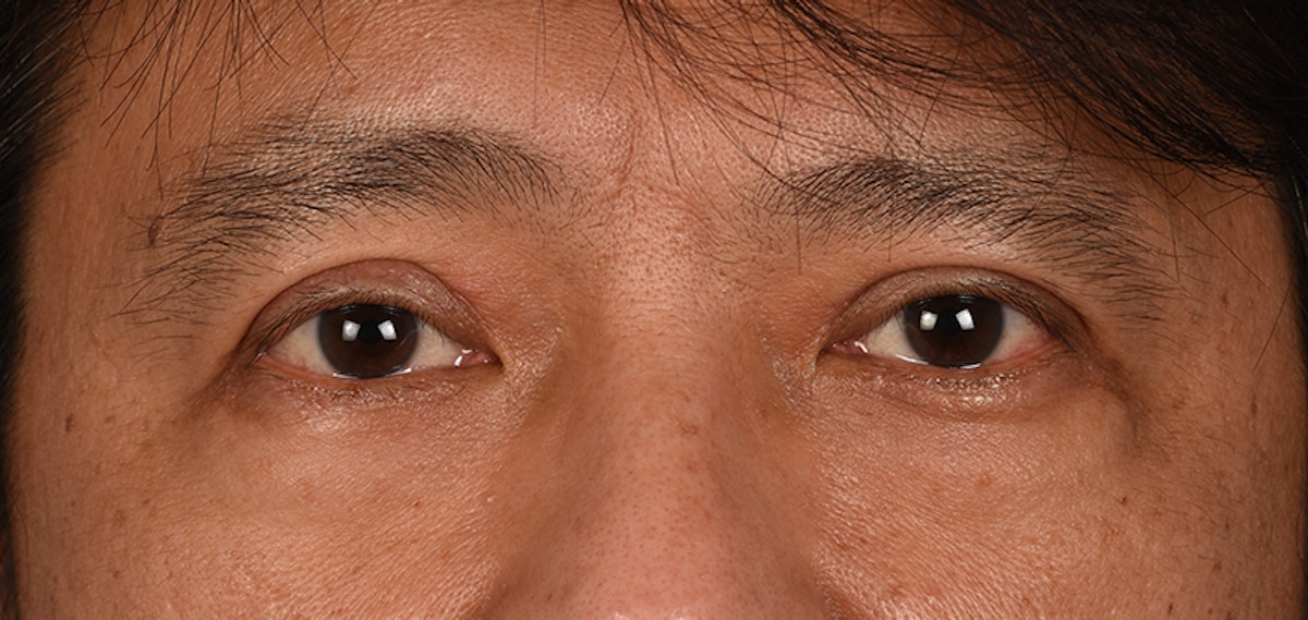 Blepharoplasty Before & After Gallery - Patient 394322 - Image 2
