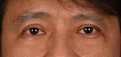 Blepharoplasty Before & After Gallery - Patient 394322 - Image 2