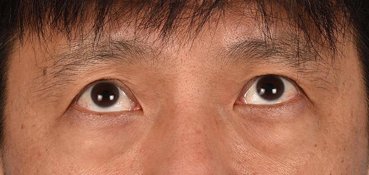 Blepharoplasty Before & After Gallery - Patient 394322 - Image 3