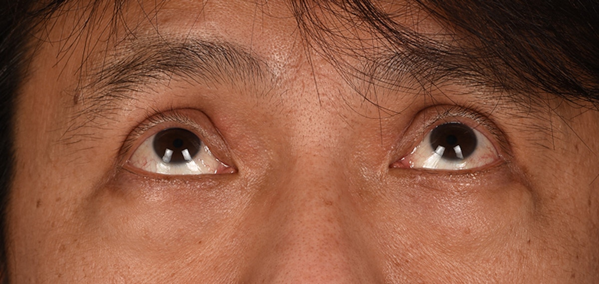 Blepharoplasty Before & After Gallery - Patient 394322 - Image 4