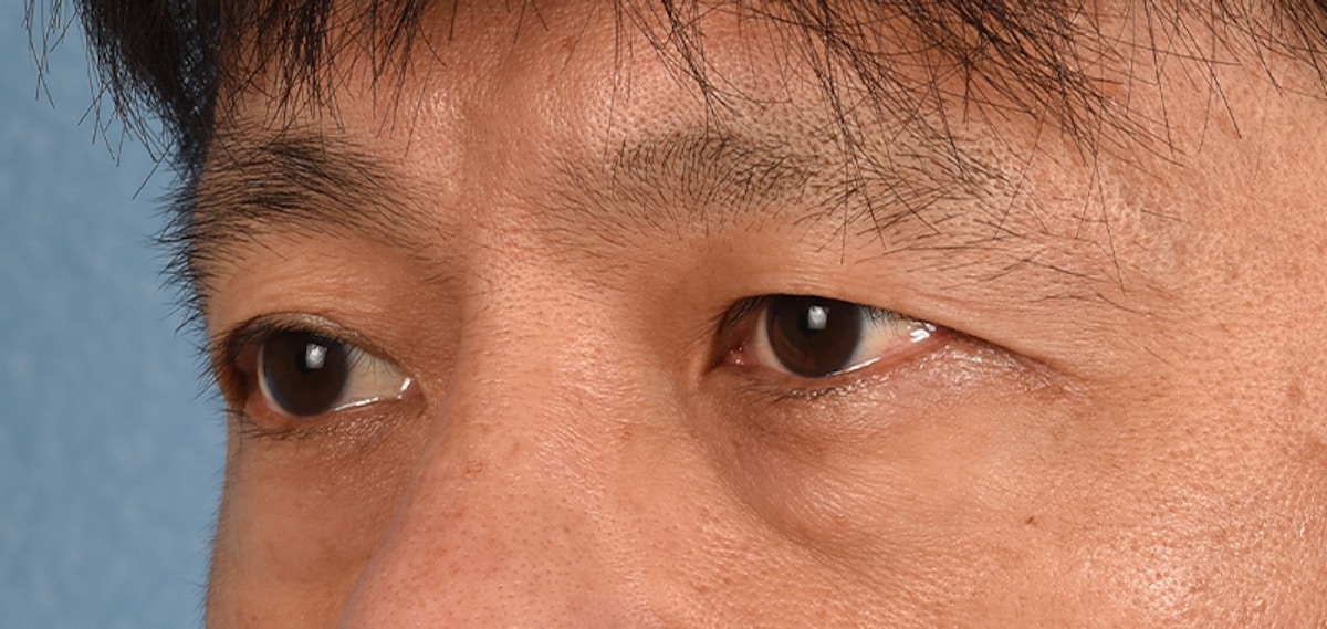 Blepharoplasty Before & After Gallery - Patient 394322 - Image 5
