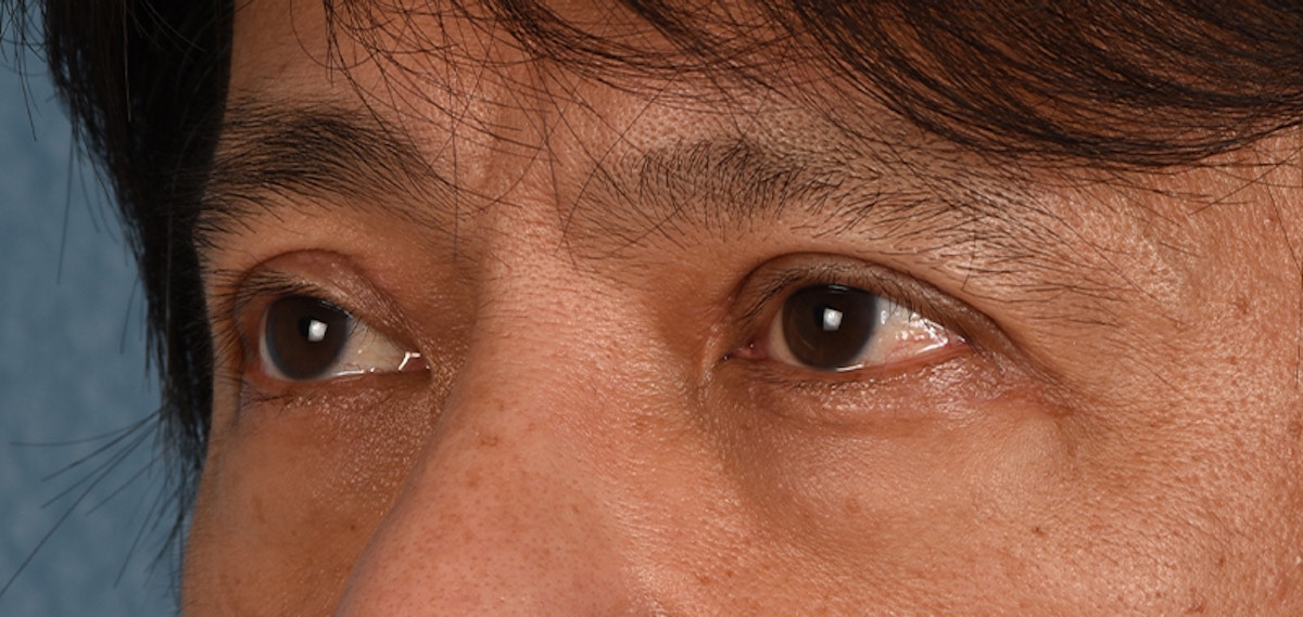 Blepharoplasty Before & After Gallery - Patient 394322 - Image 6