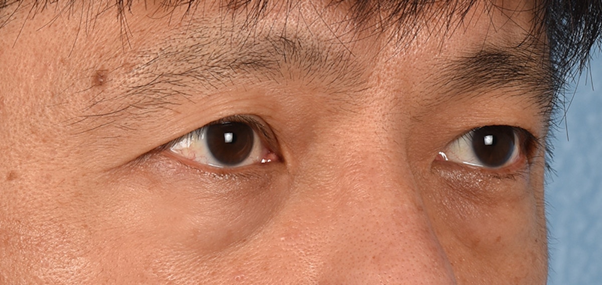 Blepharoplasty Before & After Gallery - Patient 394322 - Image 7