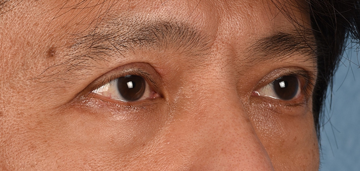 Blepharoplasty Before & After Gallery - Patient 394322 - Image 8