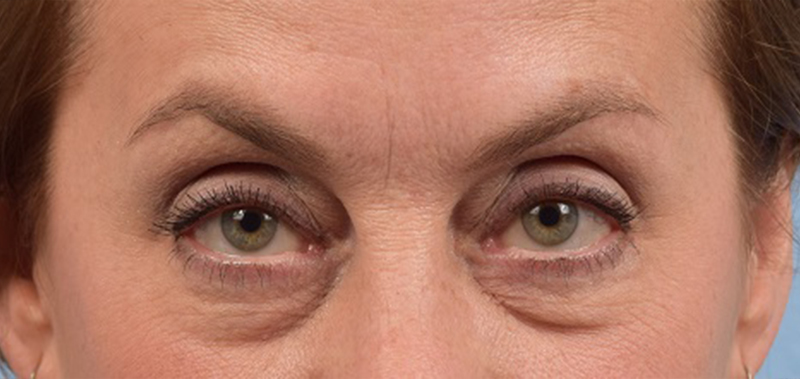 Hidden Patients Before & After Gallery - Patient 132269 - Image 1