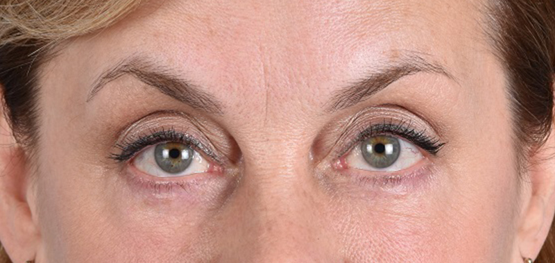 Hidden Patients Before & After Gallery - Patient 132269 - Image 2