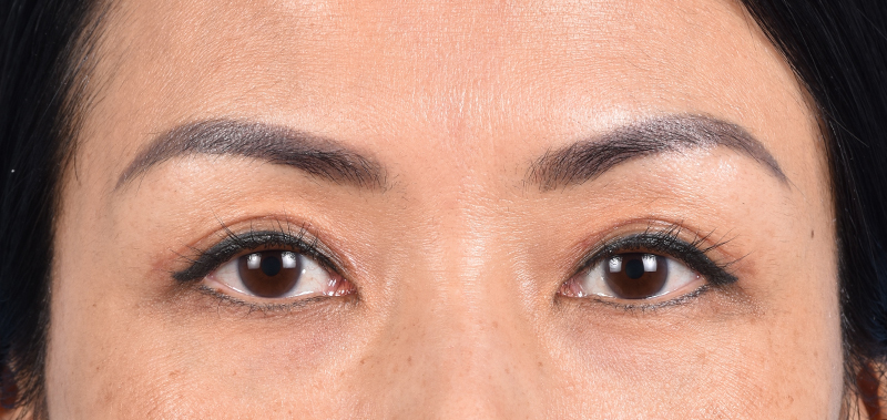 Hidden Patients Before & After Gallery - Patient 109685 - Image 2