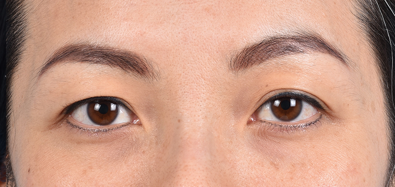 Blepharoplasty Before & After Gallery - Patient 651932 - Image 1