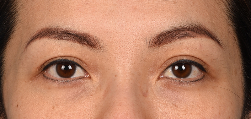 Blepharoplasty Before & After Gallery - Patient 651932 - Image 2