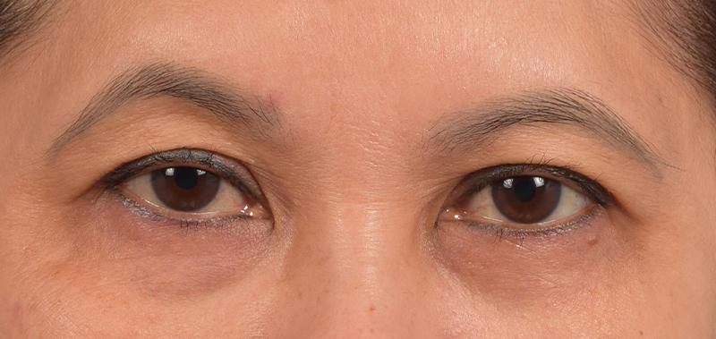 Hidden Patients Before & After Gallery - Patient 610926 - Image 1