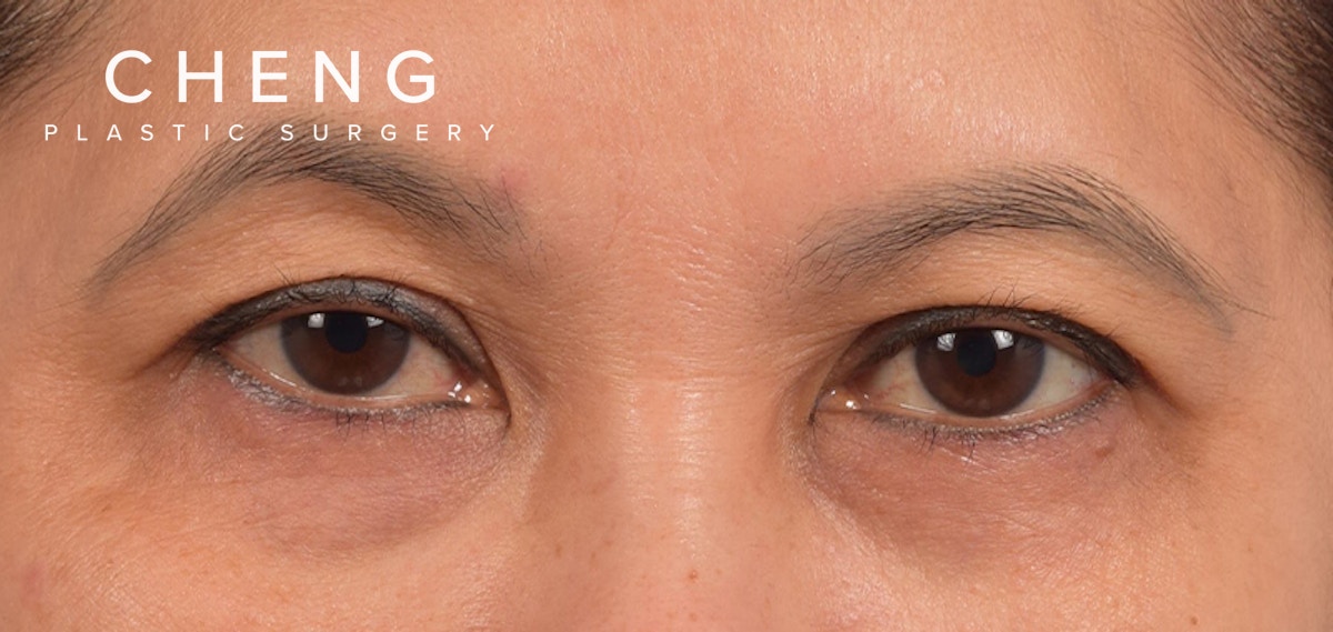 Hidden Patients Before & After Gallery - Patient 610926 - Image 1