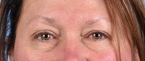 Hidden Patients Before & After Gallery - Patient 821760 - Image 1