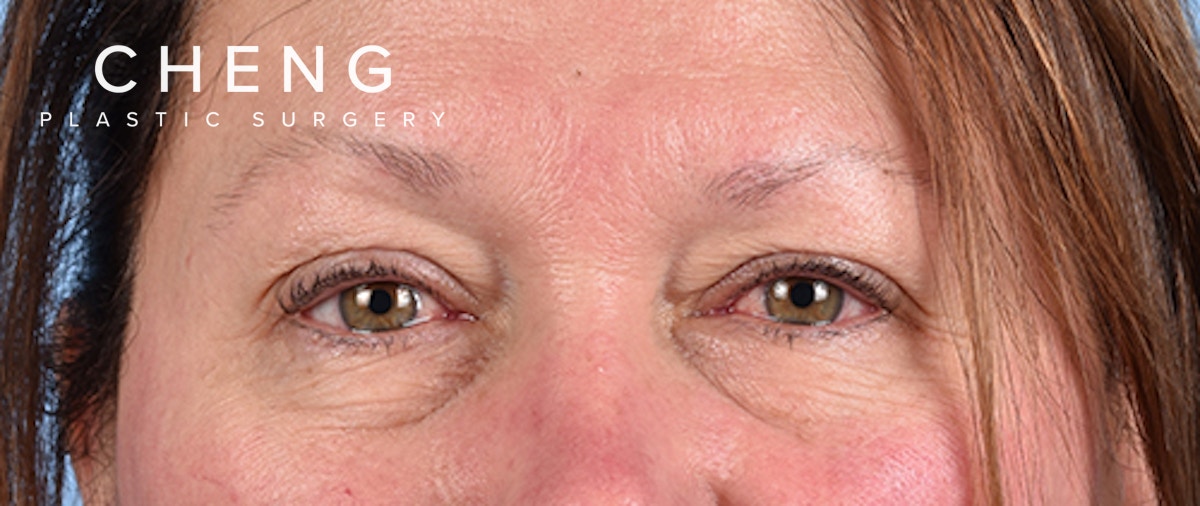 Hidden Patients Before & After Gallery - Patient 821760 - Image 1