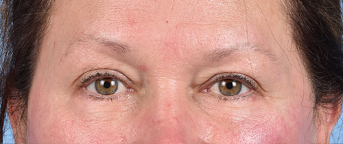 Hidden Patients Before & After Gallery - Patient 821760 - Image 2