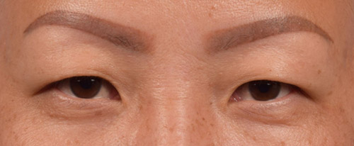 Hidden Patients Before & After Gallery - Patient 127674 - Image 1