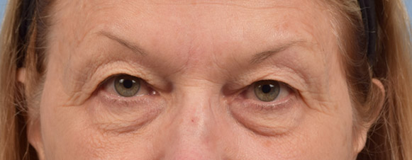 Hidden Patients Before & After Gallery - Patient 288598 - Image 1