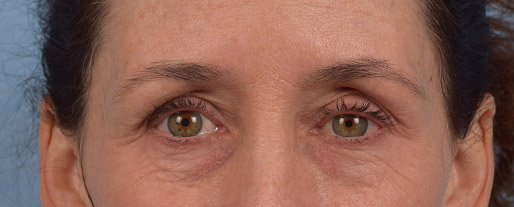 Hidden Patients Before & After Gallery - Patient 440219 - Image 1