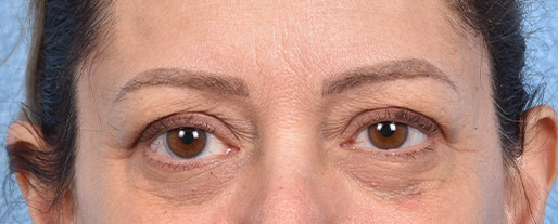 Fat Transfer Before & After Gallery - Patient 147269 - Image 1