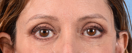 Fat Transfer Before & After Gallery - Patient 147269 - Image 2