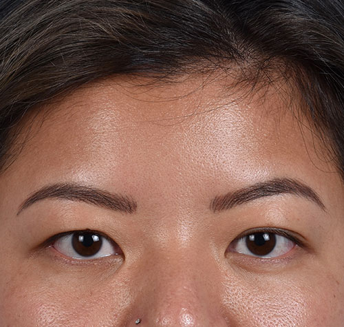 Hidden Patients Before & After Gallery - Patient 392040 - Image 1