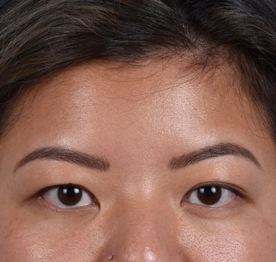 Hidden Patients Before & After Gallery - Patient 392040 - Image 1