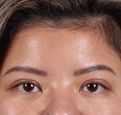 Hidden Patients Before & After Gallery - Patient 392040 - Image 2