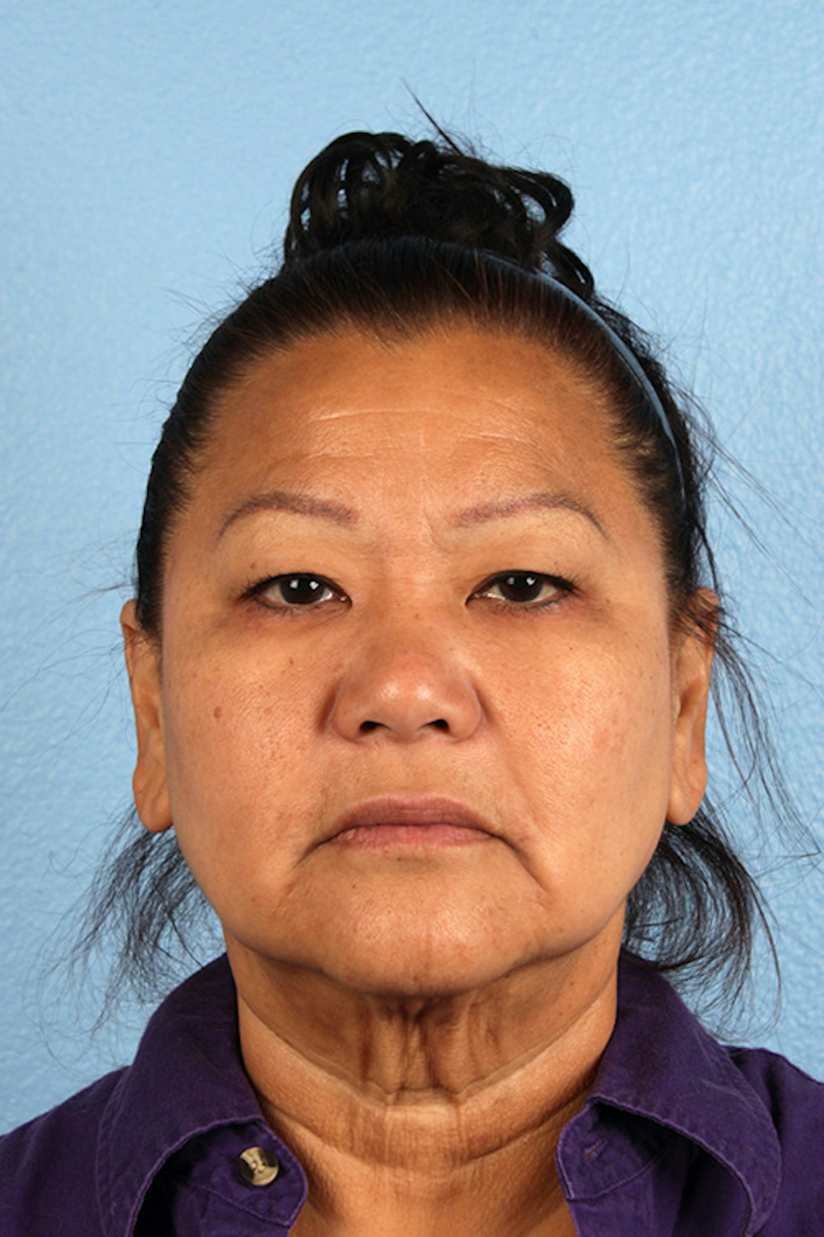 Facelift Before & After Gallery - Patient 443971 - Image 1