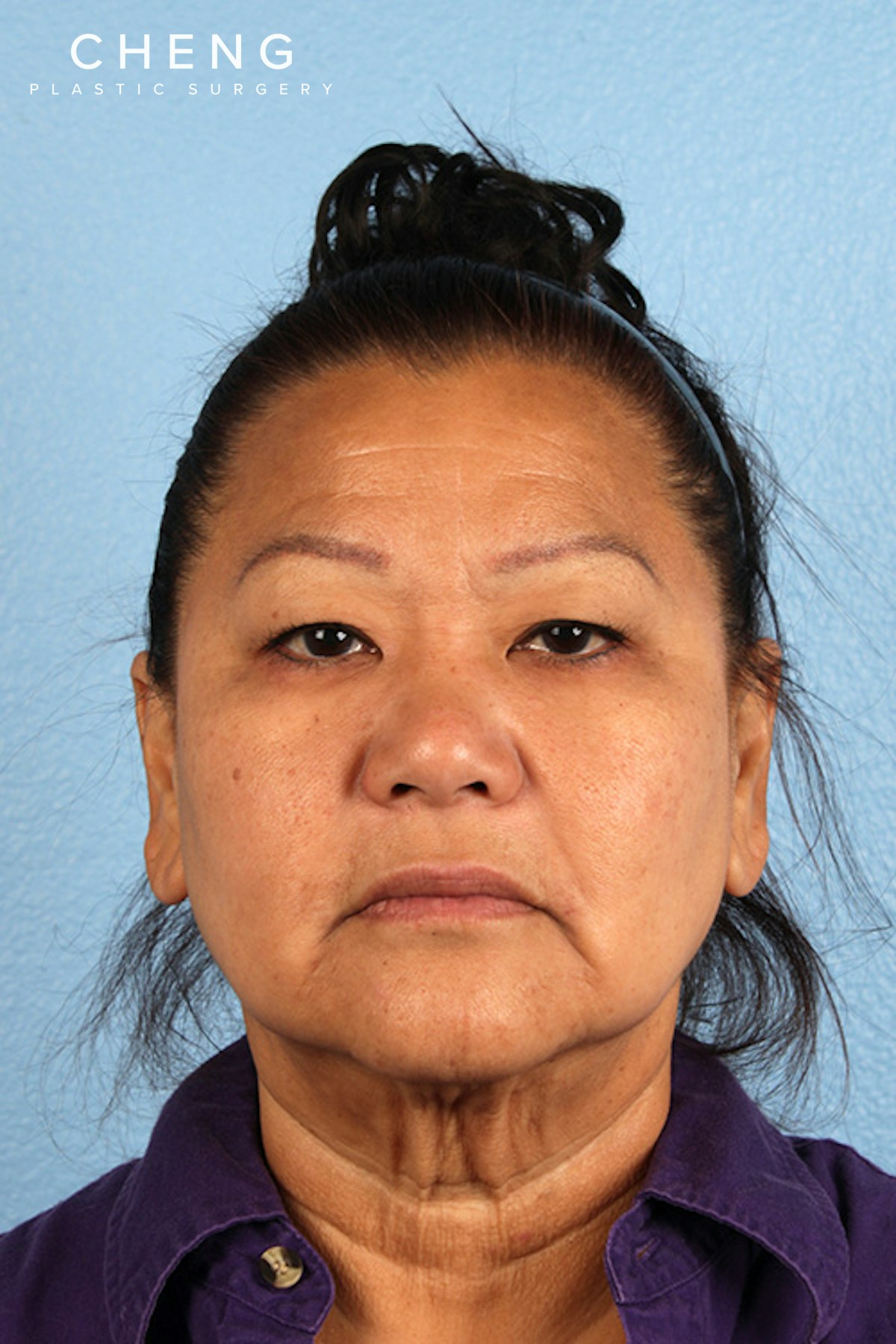 Hidden Patients Before & After Gallery - Patient 878710 - Image 1