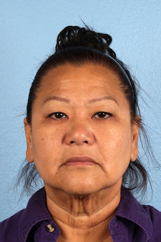 Hidden Patients Before & After Gallery - Patient 878710 - Image 1