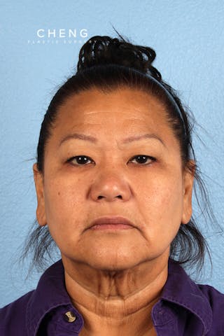 Hidden Patients Before & After Gallery - Patient 339411 - Image 1