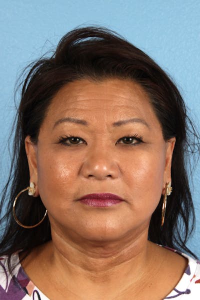 Facelift Before & After Gallery - Patient 443971 - Image 2